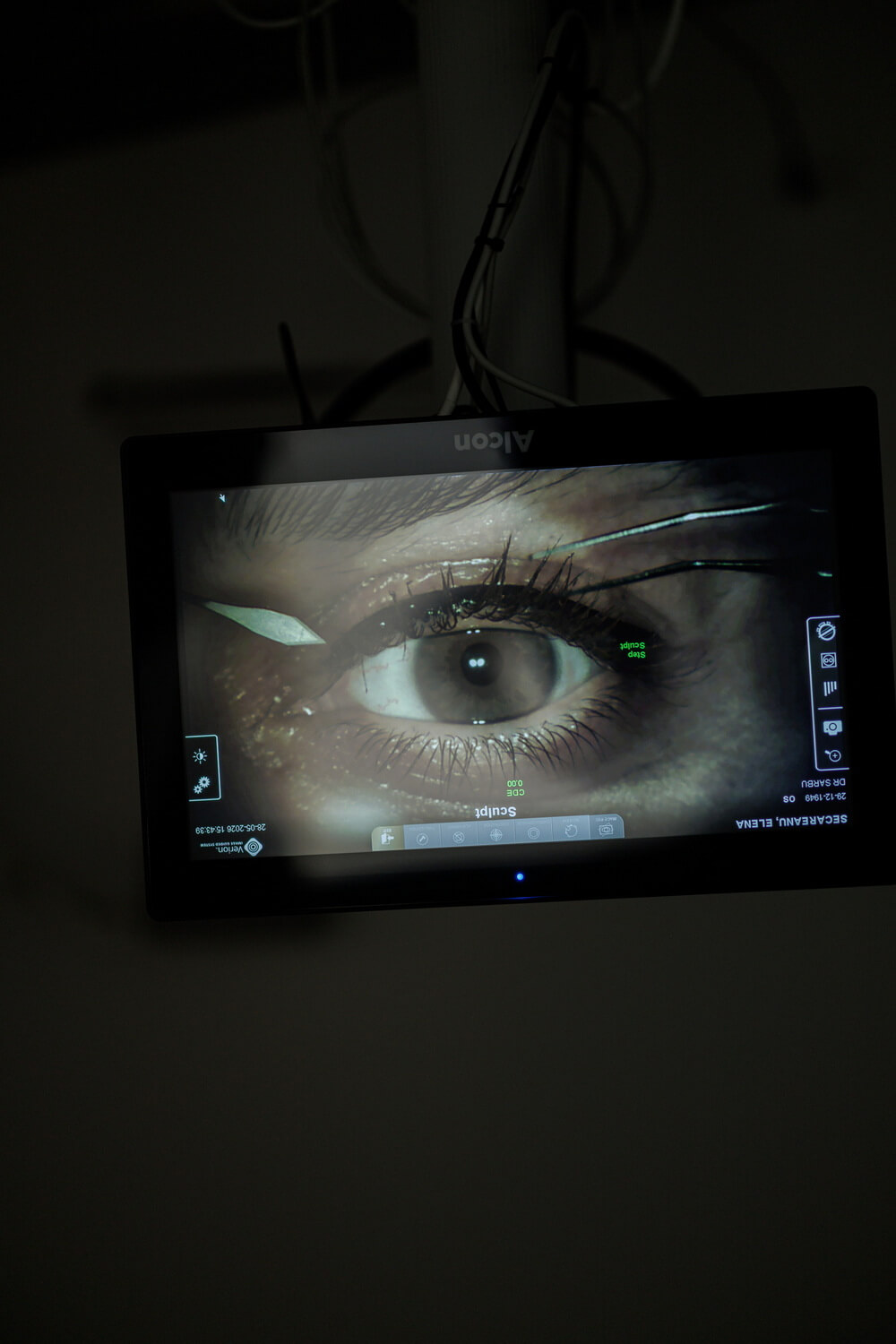 Imagine intraoperatorie din operația de cataractă, pe sistemul Alcon Verion